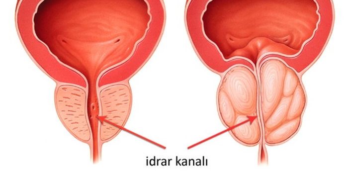 40 YAŞINDAN SONRA ERKEKLERİN ORTAK SORUNU: PROSTAT BÜYÜMESİ